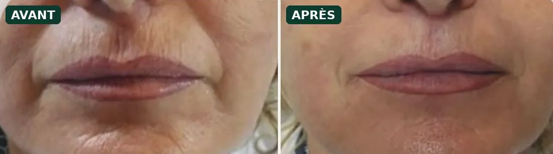 HIFU avant / après sur le contour de la bouche
